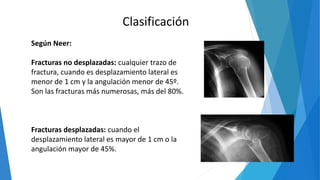 Clasificación
Según Neer:
Fracturas no desplazadas: cualquier trazo de
fractura, cuando es desplazamiento lateral es
menor de 1 cm y la angulación menor de 45º.
Son las fracturas más numerosas, más del 80%.
Fracturas desplazadas: cuando el
desplazamiento lateral es mayor de 1 cm o la
angulación mayor de 45%.
 