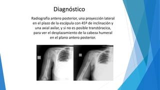 Radiografía antero posterior, una proyección lateral
en el plazo de la escápula con 45º de inclinación y
una axial axilar, y si no es posible transtóracica,
para ver el desplazamiento de la cabeza humeral
en el plano antero posterior.
Diagnóstico
 