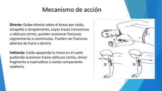 Directo: Golpe directo sobre el brazo por caída,
atropello o atrapamiento, cuyos trazos transversos
u oblicuos cortos, pueden ocasionar fracturas
segmentarias o conminutas. Pueden ser fracturas
abiertas de fuera a dentro.
Indirecto: Caída apoyando la mano en el suelo
pudiendo ocasionar trazos oblicuos cortos, tercer
fragmento o espiroideos si existe componente
rotatorio.
Mecanismo de acción
 