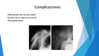 Complicaciones
•Afectación del nervio radial
•Lesión de la arteria humeral
•Pseudoartrosis
 