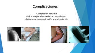 Complicaciones
-Compresión nerviosa
-Irritación por el material de osteosíntesis
-Retardo en la consolidación y seudoartrosis
 
