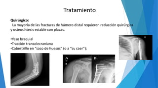 Tratamiento
Quirúrgico:
La mayoría de las fracturas de húmero distal requieren reducción quirúrgica
y osteosíntesis estable con placas.
•Yeso braquial
•Tracción transolecraniana
•Cabestrillo en “saco de huesos” (o a “su caer”):
 
