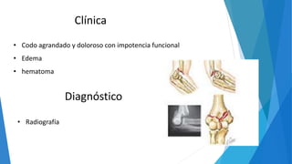 Clínica
• Codo agrandado y doloroso con impotencia funcional
• Edema
• hematoma
Diagnóstico
• Radiografía
 