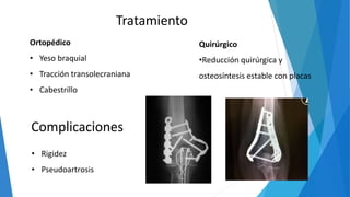 Tratamiento
Ortopédico
• Yeso braquial
• Tracción transolecraniana
• Cabestrillo
Quirúrgico
•Reducción quirúrgica y
osteosíntesis estable con placas
Complicaciones
• Rigidez
• Pseudoartrosis
 
