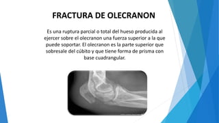 FRACTURA DE OLECRANON
Es una ruptura parcial o total del hueso producida al
ejercer sobre el olecranon una fuerza superior a la que
puede soportar. El olecranon es la parte superior que
sobresale del cúbito y que tiene forma de prisma con
base cuadrangular.
 