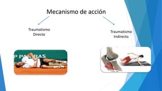 Mecanismo de acción
Traumatismo
Directo
Traumatismo
Indirecto
 