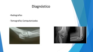 Diagnóstico
-Radiografías
-Tomografías Computarizadas
 