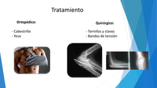 Tratamiento
Ortopédico:
- Cabestrillo
- Yeso
Quirúrgico:
- Tornillos y clavos
- Bandas de tensión
 