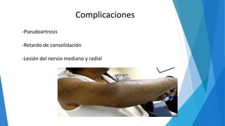 Complicaciones
-Pseudoartrosis
-Retardo de consolidación
-Lesión del nervio mediano y radial
 
