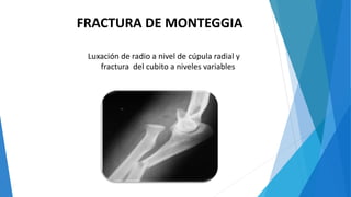FRACTURA DE MONTEGGIA
Luxación de radio a nivel de cúpula radial y
fractura del cubito a niveles variables
 