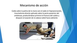 Mecanismo de acción
Caída sobre la palma de la mano con el codo en hiperpronación,
traumatismo directo aplicado sobre la parte posterior del
antebrazo, produciéndose primero la fractura del cubito y
después la luxación de la cabeza radial hacia adelante
 