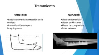 Tratamiento
Ortopédico: Quirúrgico:
•Reducción mediante tracción de la
muñeca
•Inmovilización con yeso
braquiopalmar
•Clavo andomedular
•Clavos de kirschner
•Placas de compresión
•Tutor externo
 