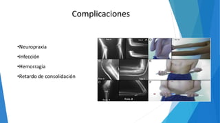 Complicaciones
•Neuropraxia
•Infección
•Hemorragia
•Retardo de consolidación
 