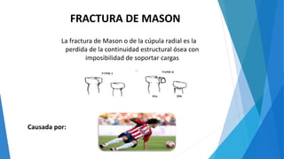 FRACTURA DE MASON
La fractura de Mason o de la cúpula radial es la
perdida de la continuidad estructural ósea con
imposibilidad de soportar cargas
Causada por:
 