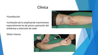 Clínica
•Tumefacción
•Limitación de la amplitud de movimientos
especialmente los de prono supinación del
antebrazo y extensión de codo
•Dolor intenso
 