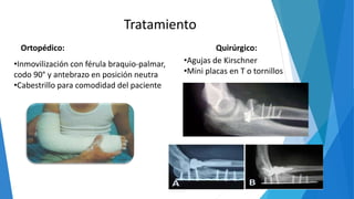 Tratamiento
Ortopédico: Quirúrgico:
•Inmovilización con férula braquio-palmar,
codo 90° y antebrazo en posición neutra
•Cabestrillo para comodidad del paciente
•Agujas de Kirschner
•Mini placas en T o tornillos
 