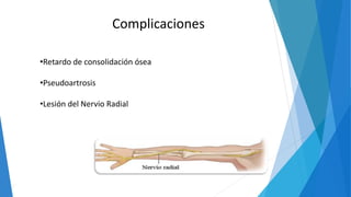 Complicaciones
•Retardo de consolidación ósea
•Pseudoartrosis
•Lesión del Nervio Radial
 