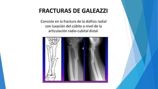 FRACTURAS DE GALEAZZI
Consiste en la fractura de la diáfisis radial
con luxación del cúbito a nivel de la
articulación radio-cubital distal.
 