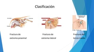 Clasificación
Fractura de Fractura de Fractura del
extremo proximal extremo lateral tercio medio
 