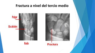 Fractura a nivel del tercio medio
 