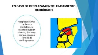 EN CASO DE DESPLAZAMIENTO: TRATAMIENTO
QUIRÚRGICO
Desplazadas mas
de 1mm e
inestables, se
realiza reduccion
abierta, fijacion y
compresion con
tornillo de
minifragmentos.
 