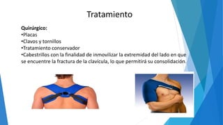 Quirúrgico:
•Placas
•Clavos y tornillos
•Tratamiento conservador
•Cabestrillos con la finalidad de inmovilizar la extremidad del lado en que
se encuentre la fractura de la clavícula, lo que permitirá su consolidación.
Tratamiento
 