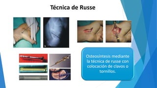 Técnica de Russe
Osteosíntesis mediante
la técnica de russe con
colocación de clavos o
tornillos.
 
