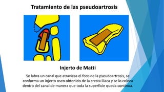 Tratamiento de las pseudoartrosis
Injerto de Matti
Se labra un canal que atraviesa el foco de la pseudoartrosis, se
conforma un injerto oseo obtenido de la cresta iliaca y se lo coloca
dentro del canal de manera que toda la superficie queda continua.
 