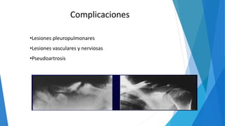 •Lesiones pleuropulmonares
•Lesiones vasculares y nerviosas
•Pseudoartrosis
Complicaciones
 
