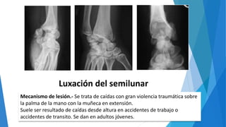 Luxación del semilunar
Mecanismo de lesión.- Se trata de caídas con gran violencia traumática sobre
la palma de la mano con la muñeca en extensión.
Suele ser resultado de caídas desde altura en accidentes de trabajo o
accidentes de transito. Se dan en adultos jóvenes.
 