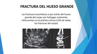 FRACTURA DEL HUESO GRANDE
Las fracturas traumáticas o por estrés del hueso
grande del carpo son hallazgos realmente
infrecuentes en la práctica clínica (13% de todas
las fracturas del carpo)
 
