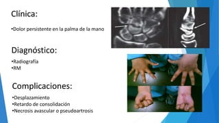 Clínica:
•Dolor persistente en la palma de la mano
Diagnóstico:
•Radiografía
•RM
Complicaciones:
•Desplazamiento
•Retardo de consolidación
•Necrosis avascular o pseudoartrosis
 