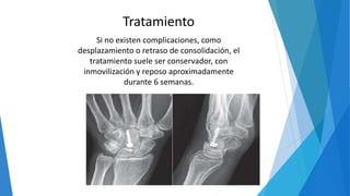 Tratamiento
Si no existen complicaciones, como
desplazamiento o retraso de consolidación, el
tratamiento suele ser conservador, con
inmovilización y reposo aproximadamente
durante 6 semanas.
 