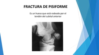 FRACTURA DE PISIFORME
Es un hueso que está rodeado por el
tendón del cubital anterior
 