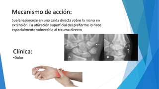 Mecanismo de acción:
Suele lesionarse en una caída directa sobre la mano en
extensión. La ubicación superficial del pisiforme lo hace
especialmente vulnerable al trauma directo
Clínica:
•Dolor
 