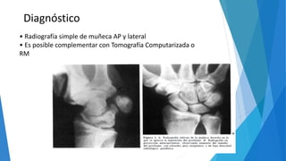 • Radiografía simple de muñeca AP y lateral
• Es posible complementar con Tomografía Computarizada o
RM
Diagnóstico
 