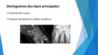 Distinguimos dos tipos principales:
• Fracturas del cuerpo
• Fracturas del gancho o apófisis unciforme
 