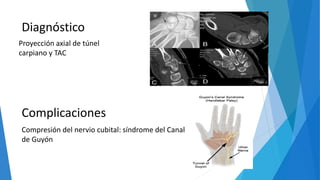 Diagnóstico
Complicaciones
Compresión del nervio cubital: síndrome del Canal
de Guyón
Proyección axial de túnel
carpiano y TAC
 