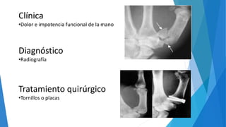 Clínica
•Dolor e impotencia funcional de la mano
Diagnóstico
•Radiografía
Tratamiento quirúrgico
•Tornillos o placas
 