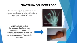FRACTURA DEL BOXEADOR
Es una lesión que se produce en la
mano. Consiste en la rotura o fractura
del quinto metacarpiano
Mecanismo de acción:
Se produce al golpear una
superficie dura con el puño
cerrado, de ahí a que esta lesión
se le conozca como fractura de
boxeador
 