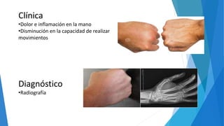 Clínica
•Dolor e inflamación en la mano
•Disminución en la capacidad de realizar
movimientos
Diagnóstico
•Radiografía
 