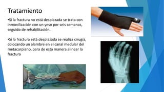 Tratamiento
•Si la fractura no está desplazada se trata con
inmovilización con un yeso por seis semanas,
seguido de rehabilitación.
•Si la fractura está desplazada se realiza cirugía,
colocando un alambre en el canal medular del
metacarpiano, para de esta manera alinear la
fractura
 