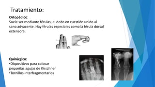 Tratamiento:
Ortopédico:
Suele ser mediante férulas, el dedo en cuestión unido al
sano adyacente. Hay férulas especiales como la férula dorsal
extensora.
Quirúrgico:
•Dispositivos para colocar
pequeñas agujas de Kirschner
•Tornillos interfragmentarios
 