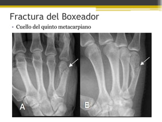 Fractura del Boxeador
• Cuello del quinto metacarpiano

 
