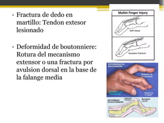 • Fractura de dedo en
martillo: Tendon extesor
lesionado
• Deformidad de boutonniere:
Rotura del mecanismo
extensor o una fractura por
avulsion dorsal en la base de
la falange media

 
