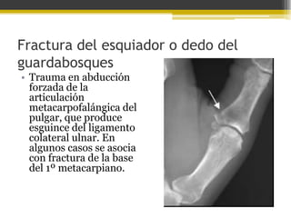 Fractura del esquiador o dedo del
guardabosques
• Trauma en abducción
forzada de la
articulación
metacarpofalángica del
pulgar, que produce
esguince del ligamento
colateral ulnar. En
algunos casos se asocia
con fractura de la base
del 1º metacarpiano.

 