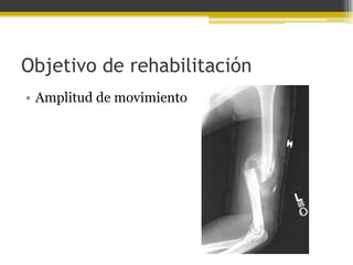 Objetivo de rehabilitación
• Amplitud de movimiento

 