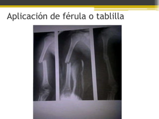 Aplicación de férula o tablilla

 
