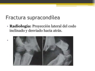 Fractura supracondílea
• Radiología: Proyección lateral del codo
inclinado y desviado hacia atrás.
•

 