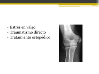 • Estrés en valgo
• Traumatismo directo
• Tratamiento ortopédico

 